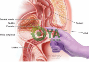 Prostrate Cancer Is Dangerous, Following Food That Prevent This