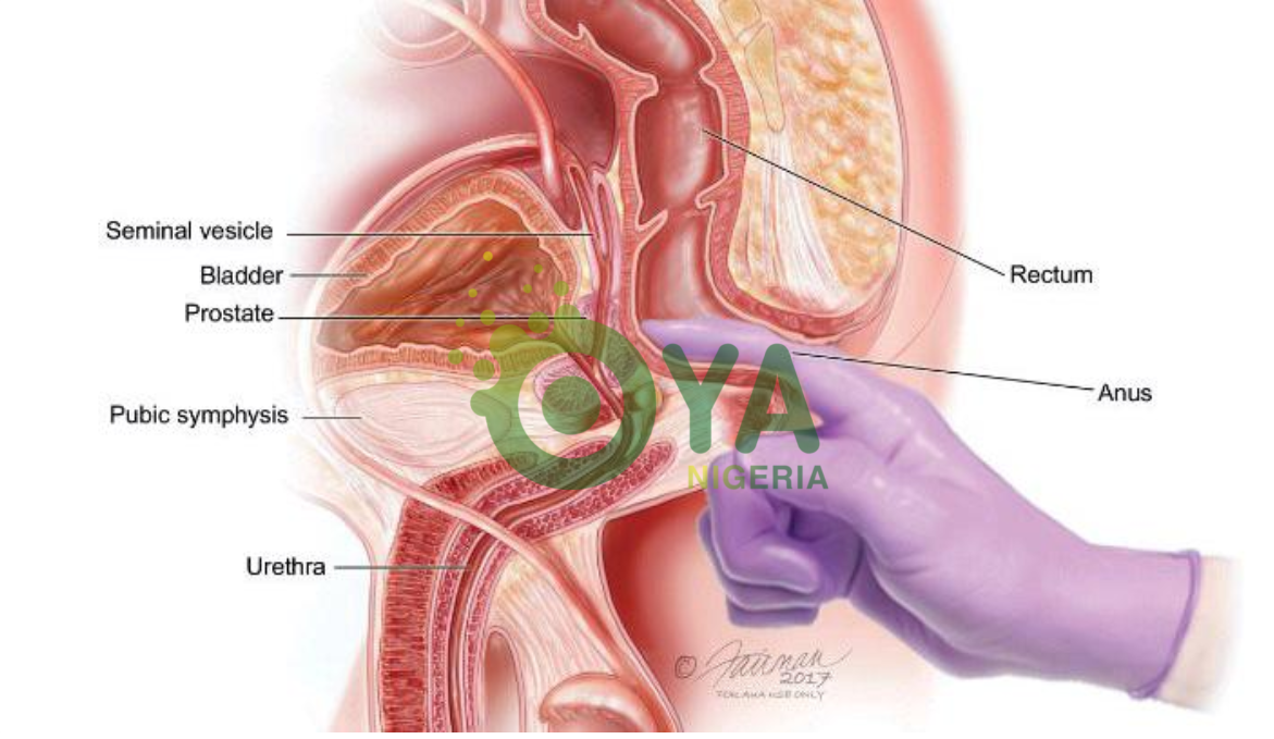 Prostrate Cancer Is Dangerous, Following Food That Prevent This