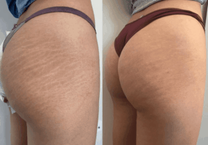 Stretch Marks Camouflage: How It Works and Why You Should Try It (JUST-IN)