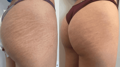Stretch Marks Camouflage: How It Works and Why You Should Try It (JUST-IN)
