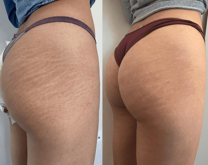 Stretch Marks Camouflage: How It Works and Why You Should Try It (JUST-IN) Stretch Marks Camouflage: How It Works and Why You Should Try It (JUST-IN)
