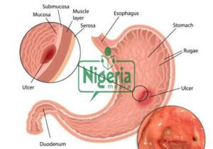 Following Food To Eat When Managing Stomach Ulcers
