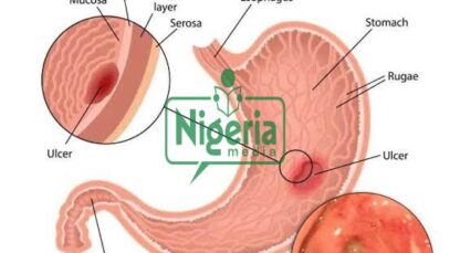 Following Food To Eat When Managing Stomach Ulcers