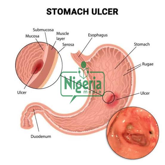 Following Food To Eat When Managing Stomach Ulcers Following Food To Eat When Managing Stomach Ulcers