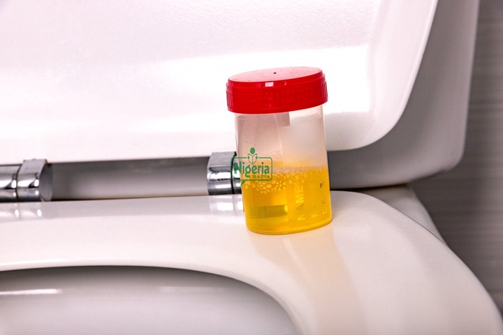 If Your Urine Always Foams, These Are It’s 5 Five Possible Causes And Foods To Watch Out For If Your Urine Always Foams, These Are It’s 5 Five Possible Causes And Foods To Watch Out For