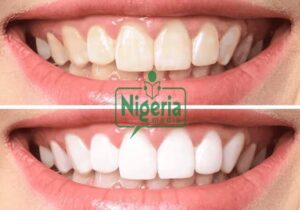 Easy ways How To Make Your Teeth White Again