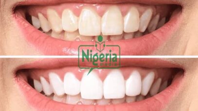 Easy ways How To Make Your Teeth White Again