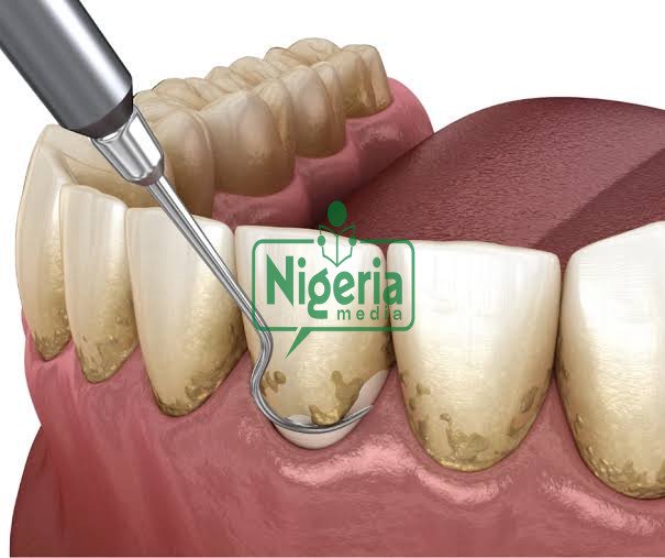 How To Remove Deep Brown Stains From Your Teeth With These Kitchen Ingredients (J How To Remove Deep Brown Stains From Your Teeth With These Kitchen Ingredients (J