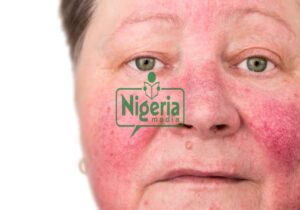 Reasons Why Alcohol Makes Your Skin Look Older And Ugly
