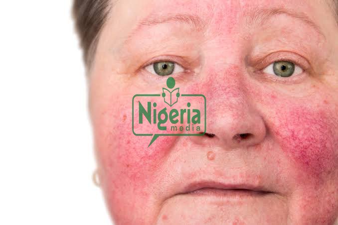 Reasons Why Alcohol Makes Your Skin Look Older And Ugly Reasons Why Alcohol Makes Your Skin Look Older And Ugly