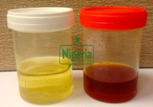 Urine Colors May Be Warning Signs Of Following Diseases, Here’s How To Tell