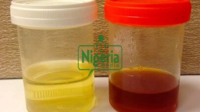 Urine Colors May Be Warning Signs Of Following Diseases, Here’s How To Tell