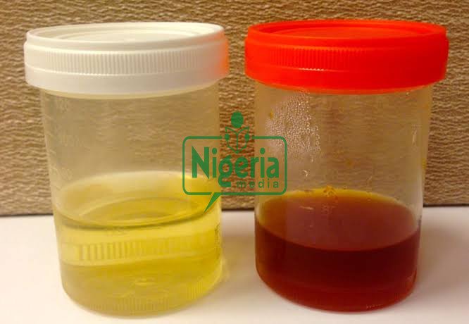 Urine Colors May Be Warning Signs Of Following Diseases, Here’s How To Tell Urine Colors May Be Warning Signs Of Following Diseases, Here’s How To Tell