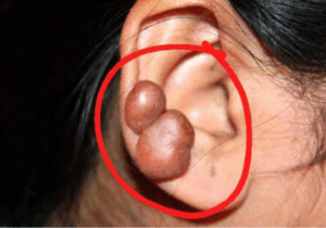 How To Get Rid Of Bumps And Keloids (JUST-IN)