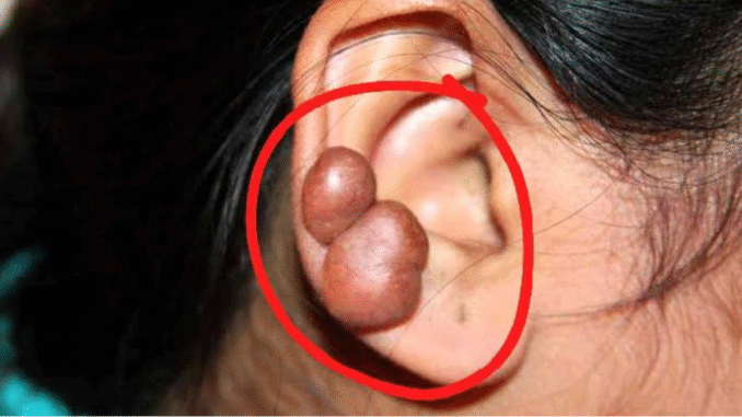 How To Get Rid Of Bumps And Keloids (JUST-IN) How To Get Rid Of Bumps And Keloids (JUST-IN)