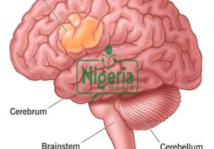 Symptoms & Signs Of Brain Cancer You Should Not Ignore