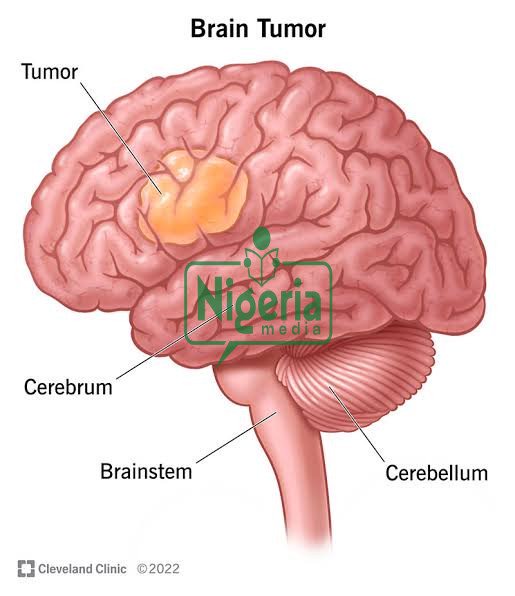 Symptoms & Signs Of Brain Cancer You Should Not Ignore Symptoms & Signs Of Brain Cancer You Should Not Ignore