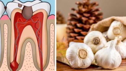 Here are Home Remedies for Toothache Instead of Going to the Dentist