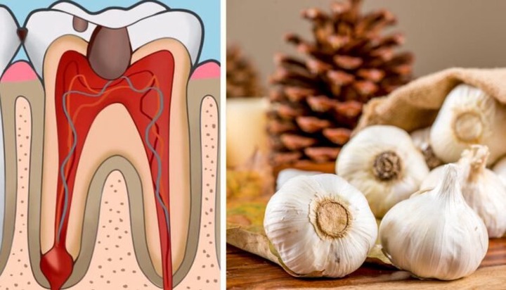 Here are Home Remedies for Toothache Instead of Going to the Dentist