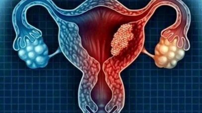 Uterine Cancer: Stay Away From These 4 Four Things To Avoid The Risk Of Being A Victim