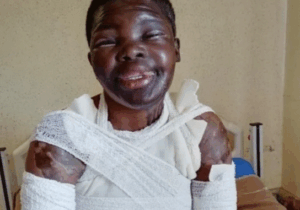 SAD!!! Limpopo Woman Shares Pain After Ex’s Jealous Lover Attacks Her with Acid