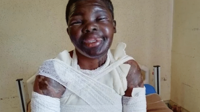 SAD!!! Limpopo Woman Shares Pain After Ex’s Jealous Lover Attacks Her with Acid SAD!!! Limpopo Woman Shares Pain After Ex’s Jealous Lover Attacks Her with Acid