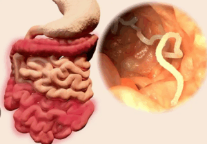 You Need To Deworm You Body If You Notice Following Five Signs