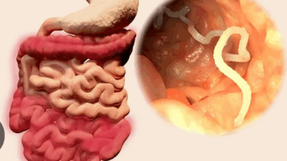 You Need To Deworm You Body If You Notice Following Five Signs