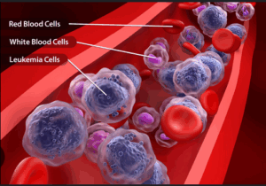 BREAKING: Blood Cancer Disease Kill Fast: If You Want To Live Long, Stop Taking These five 5 Things In Access