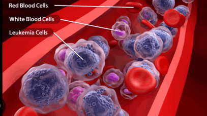 BREAKING: Blood Cancer Disease Kill Fast: If You Want To Live Long, Stop Taking These five 5 Things In Access