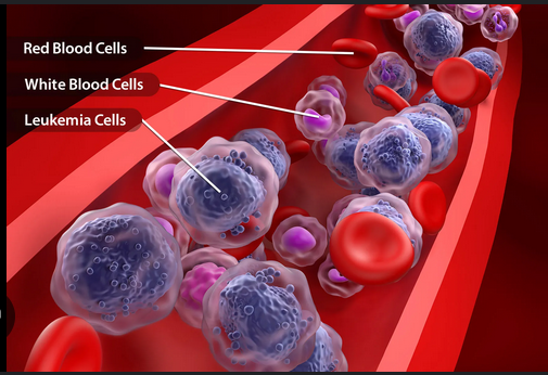 BREAKING: Blood Cancer Disease Kill Fast: If You Want To Live Long, Stop Taking These five 5 Things In Access BREAKING: Blood Cancer Disease Kill Fast: If You Want To Live Long, Stop Taking These five 5 Things In Access