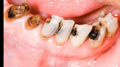 BREAKING: Stop Wasting money on dentists: Use these simple methods to cure tooth decay in your home