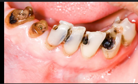 BREAKING: Stop Wasting money on dentists: Use these simple methods to cure tooth decay in your home BREAKING: Stop Wasting money on dentists: Use these simple methods to cure tooth decay in your home