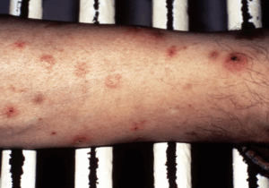 BREAKING NEWS: Important Signs Of Leukemia You Shouldn’t Ignore According To Health Experts