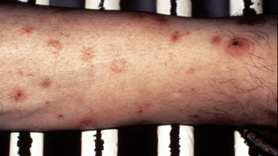 BREAKING NEWS: Important Signs Of Leukemia You Shouldn’t Ignore According To Health Experts