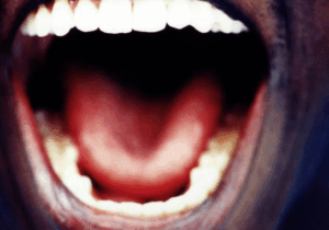 BREAKING NEWS: Tongue and Mouth Signs of HIV