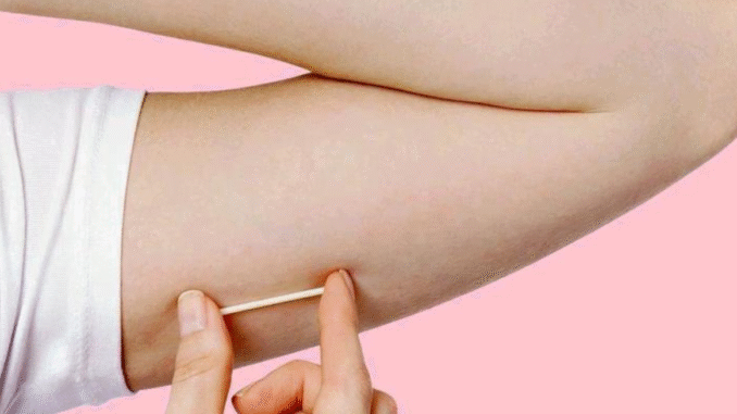BREAKING NEWS: Side Effects of Contraceptive Implant That You Need To Know