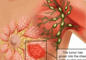 BREAKING NEWS: Essential Signs Of Breast Cancer That Are Noticeable On Some Parts Of The Body