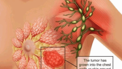 BREAKING NEWS: Essential Signs Of Breast Cancer That Are Noticeable On Some Parts Of The Body