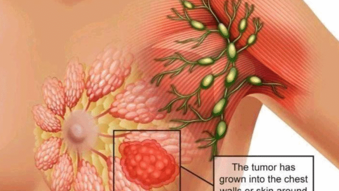 BREAKING NEWS: Essential Signs Of Breast Cancer That Are Noticeable On Some Parts Of The Body