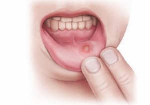 JUST-IN: Many people experience small ulcers on their gums. What can you do about canker sores?