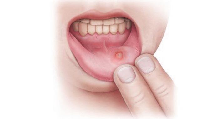 JUST-IN: Many people experience small ulcers on their gums. What can you do about canker sores? JUST-IN: Many people experience small ulcers on their gums. What can you do about canker sores?