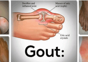 BREAKING NEWS: Say goodbye to your gout forever with this powerful natural drink