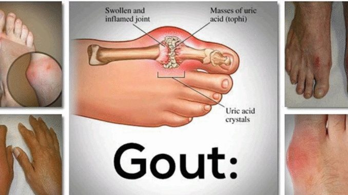 BREAKING NEWS: Say goodbye to your gout forever with this powerful natural drink