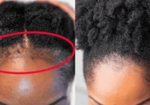 BREAKING NEWS: Grow Your Hair Line In Just 2 Weeks With These Steps
