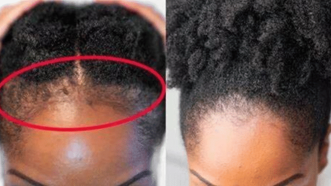 BREAKING NEWS: Grow Your Hair Line In Just 2 Weeks With These Steps BREAKING NEWS: Grow Your Hair Line In Just 2 Weeks With These Steps