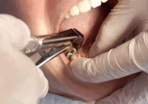 BREAKING: Quick Relief For Toothache: Home Remedies For Tooth Pain, Holes In Teeth