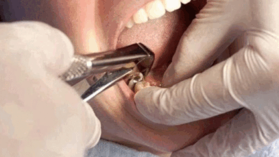 BREAKING: Quick Relief For Toothache: Home Remedies For Tooth Pain, Holes In Teeth