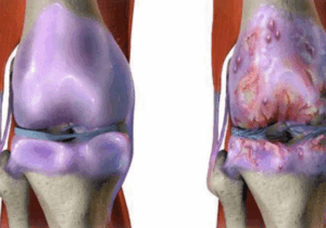 BREAKING: The Best Natural Drink To Strengthen The Knees And Help Rebuild Cartilage And Ligaments
