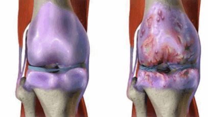 BREAKING: The Best Natural Drink To Strengthen The Knees And Help Rebuild Cartilage And Ligaments